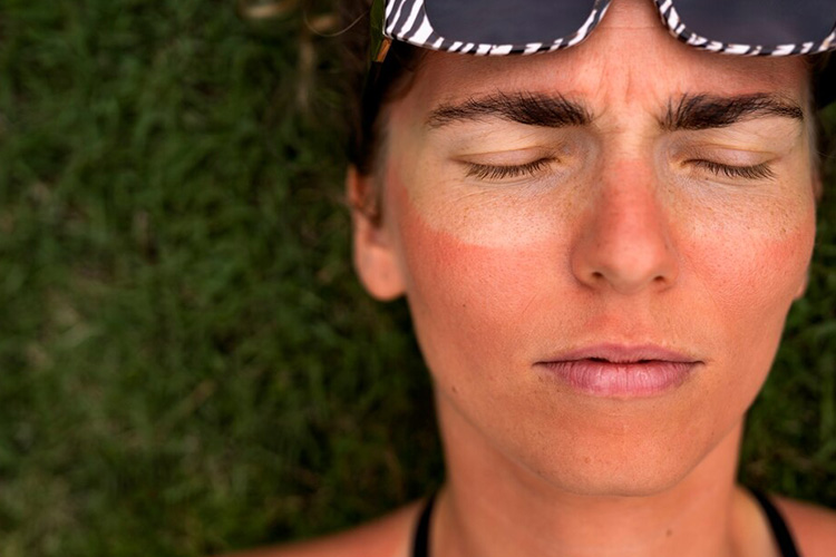 قرارگیری در معرض نور خورشید